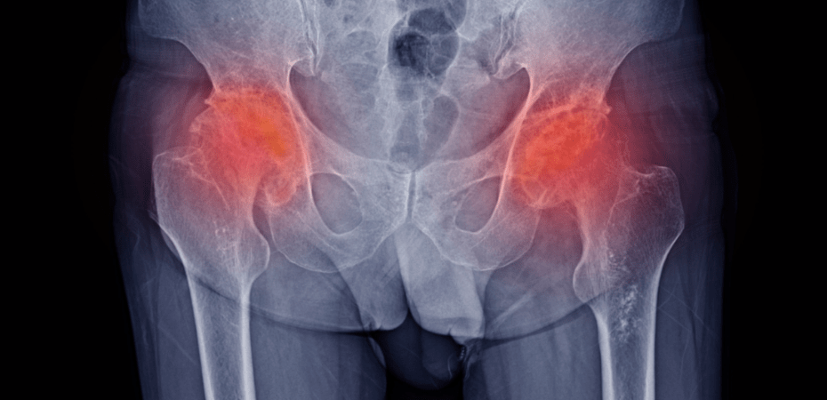 radiographie de la dysplasie de la hanche