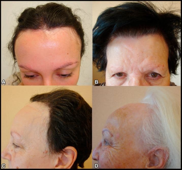 Mujeres diagnosticadas de alopecia frontal fibrosante