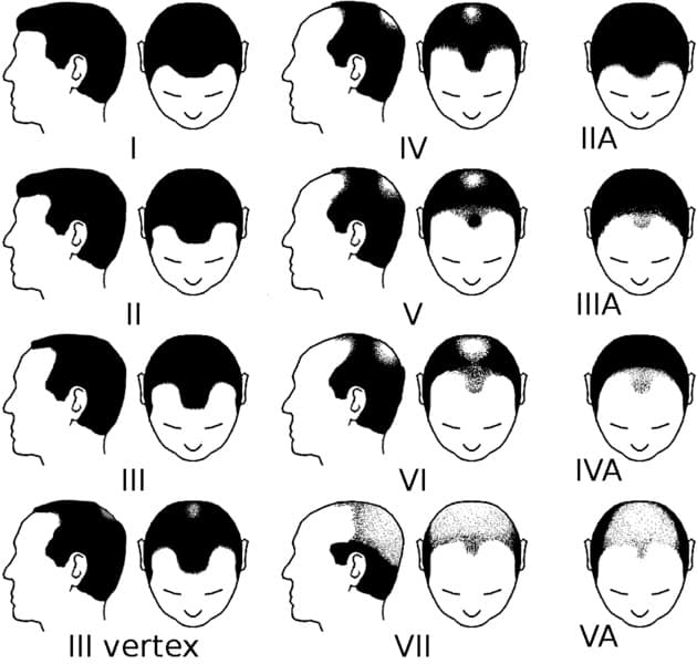 Escala Hamilton-Norwood pérdida cabello patrón masculino