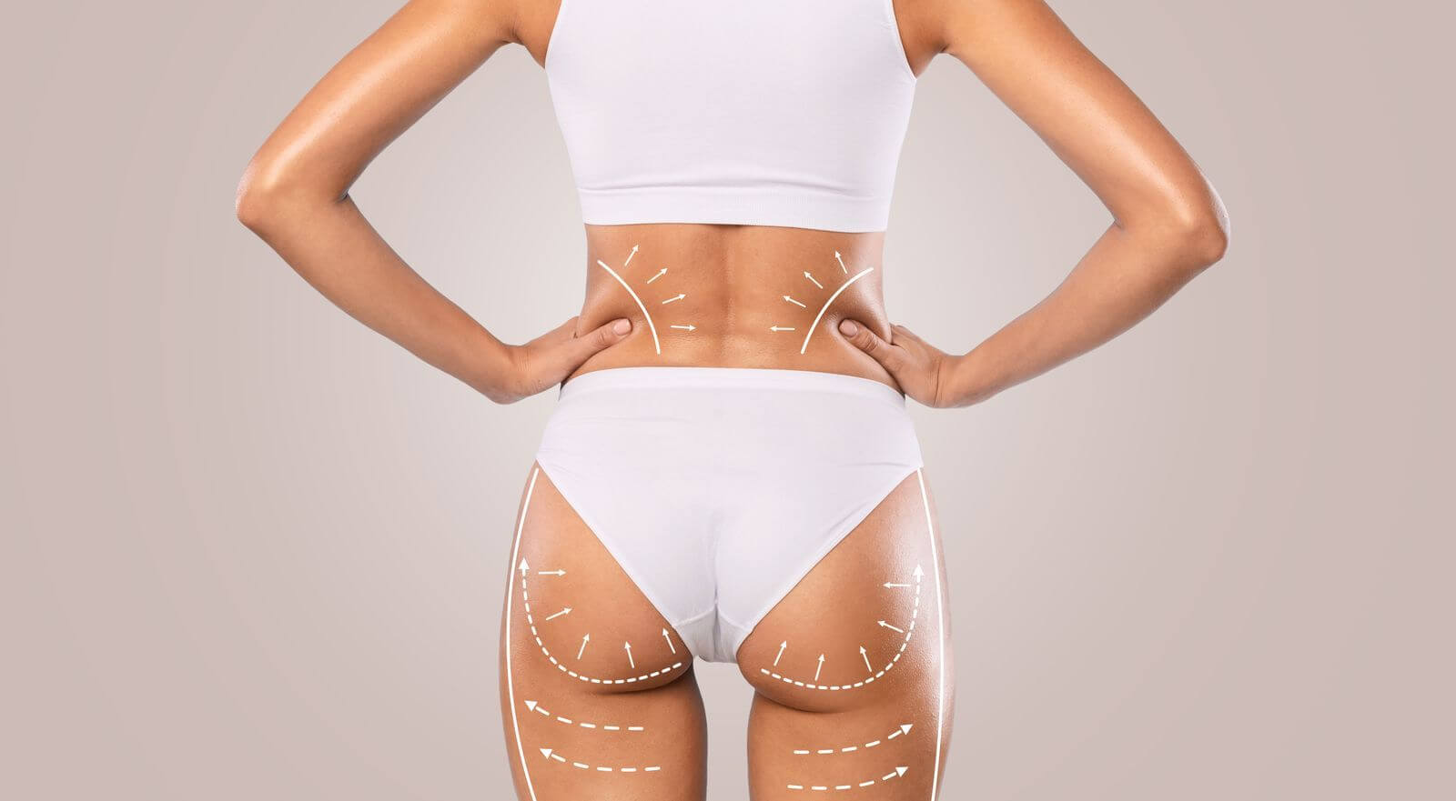 What Does Sculptra Butt Lift Mean?