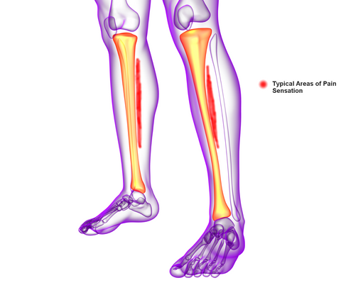 Shin Splints Pain Location Medial Tibial Stress Syndrome