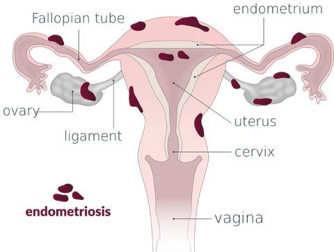 Endometriosis Diagram by Vega Asensio
