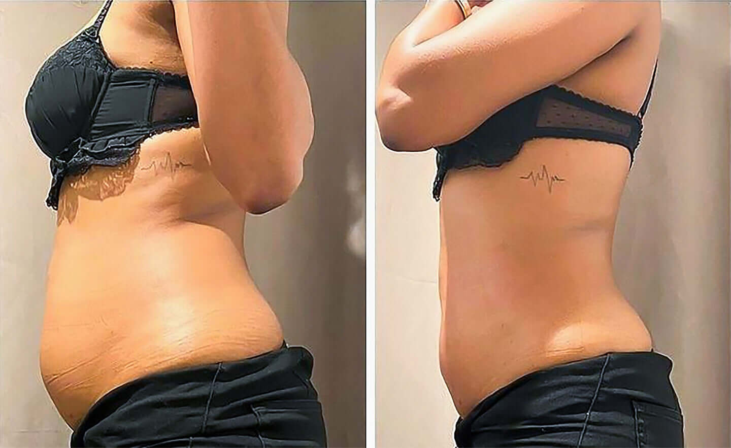 Cryo Slimming Machine Before and After Image 01