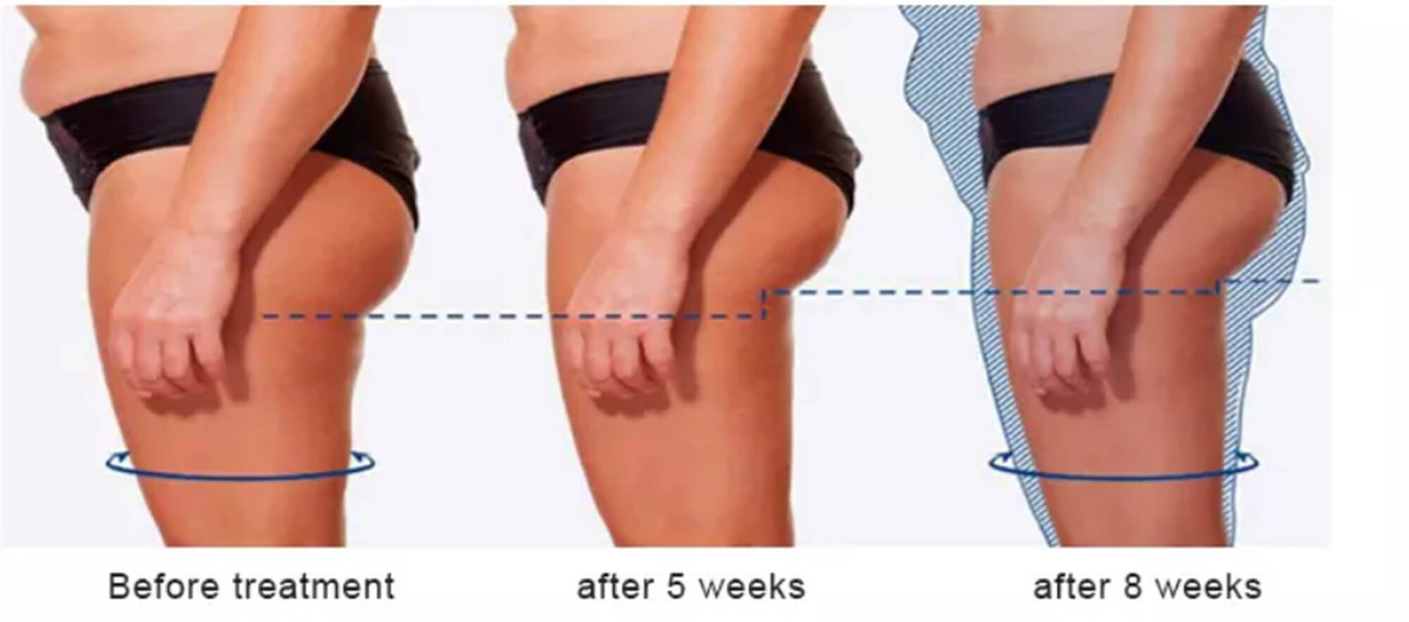 Cryo Slimming Machine Before and After Image 02