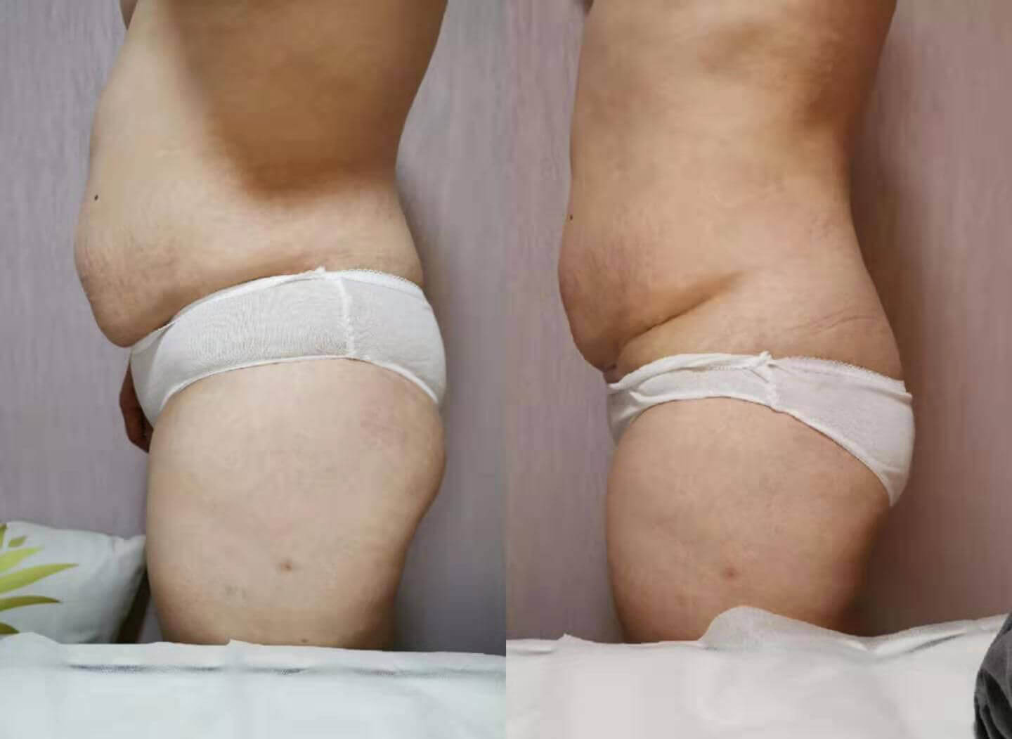 Cryo Slimming Machine Before and After Image 03