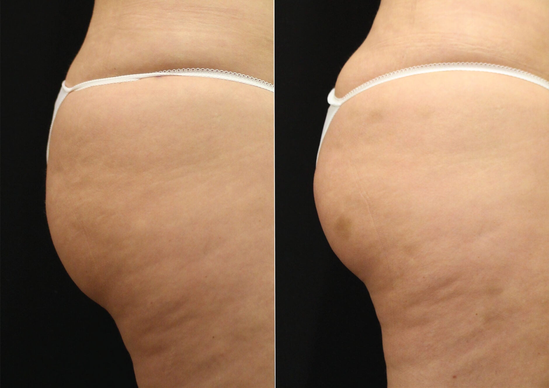 EMSculpt buttrocks before and after image 01