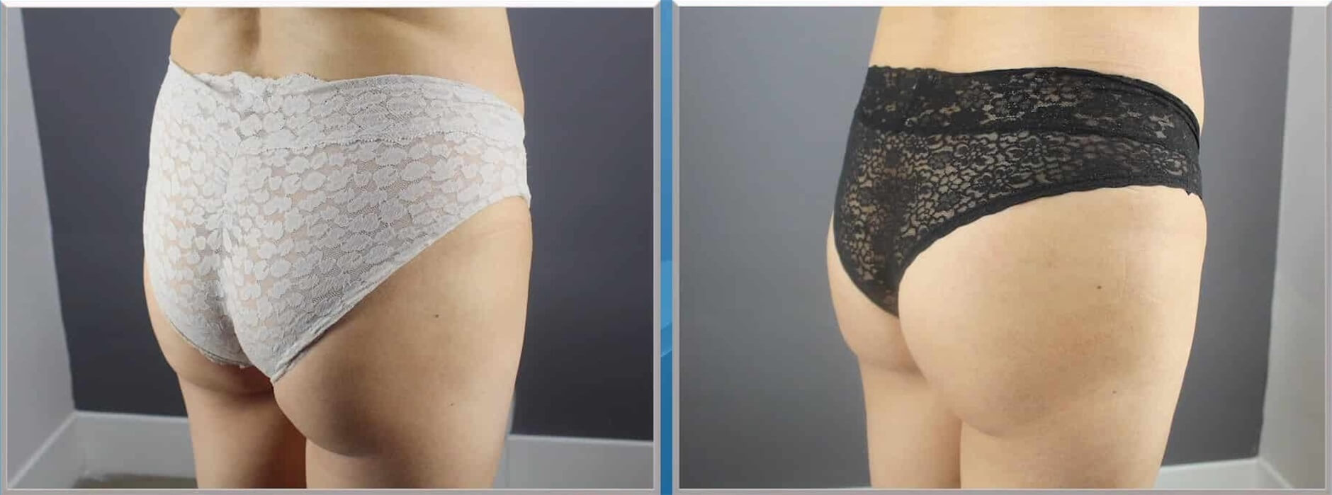 EMSculpt buttrocks before and after image 02