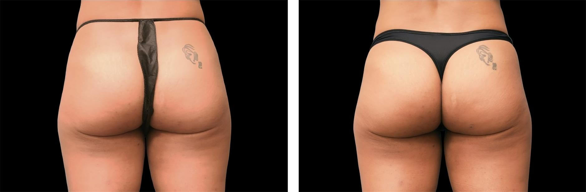 EMSculpt buttrocks before and after image 03