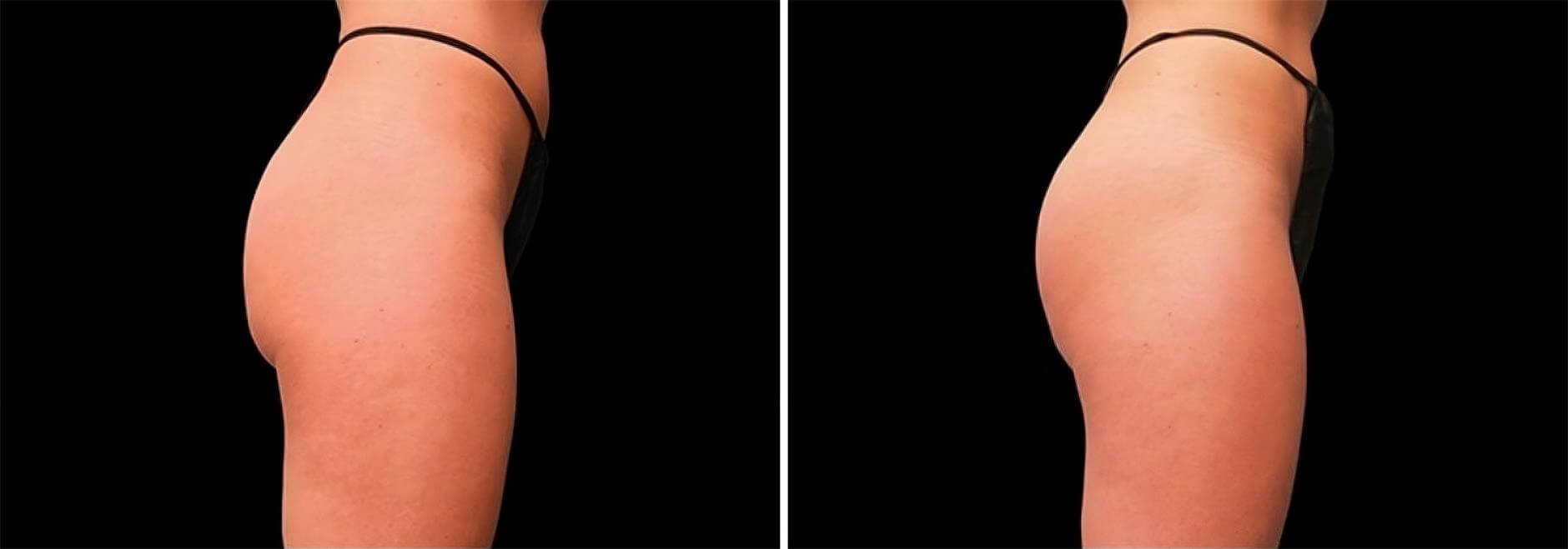 EMSculpt buttrocks before and after image 04