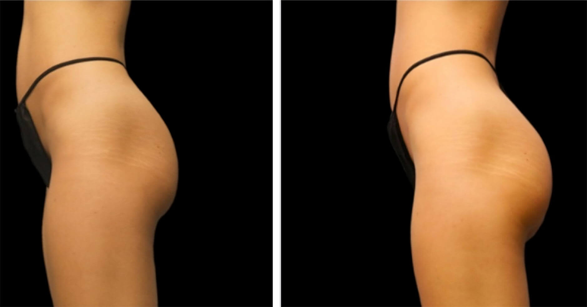 EMSculpt buttrocks before and after image 05