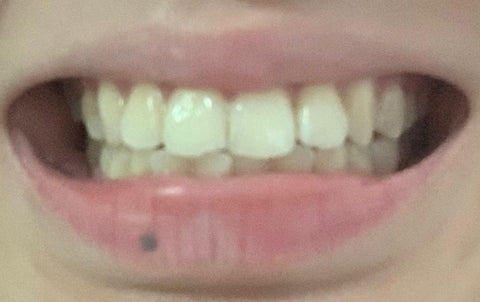 Smile Lab Review, teeth whitening strips showcasing product, recommendations for daily routine, before after results