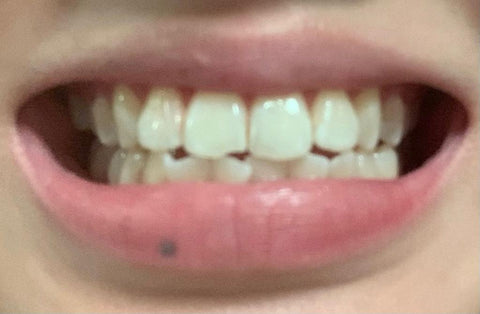 Smile Lab Review, teeth whitening strips showcasing product, recommendations for daily routine, before after results