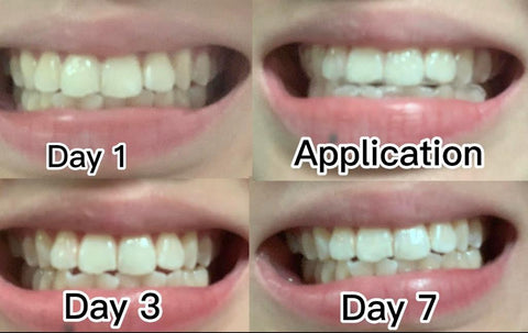 Smile Lab Review, teeth whitening strips showcasing product, recommendations for daily routine, before after results