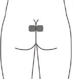 Electrode pad placement for SNS incontinence 
