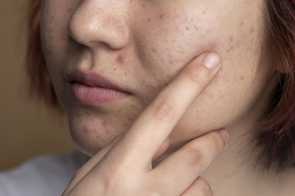 ¿Luchas contra el brillo y el acné debido a la piel grasa? Nuestro artículo te enseñará la mejor rutina para cuidar tu piel