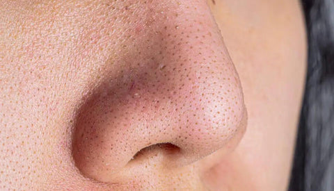 Los puntos negros son como tapones en tus poros que puedes ver en la superficie de la piel. Se forman cuando el sebo y las células muertas tapan los poros.