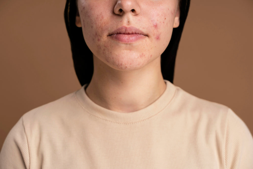 La purga en la piel suele aparecer en áreas donde normalmente se sufre de acné o imperfecciones.