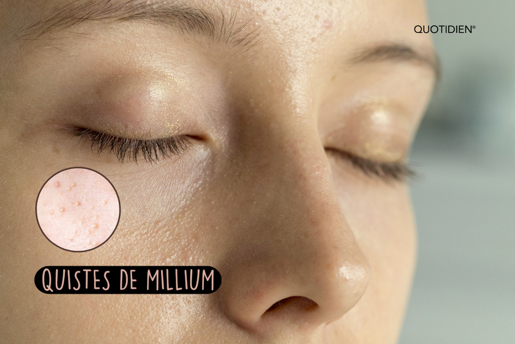 quistes-de-millium-milium-facial-puntos-blancos-cuidado-piel