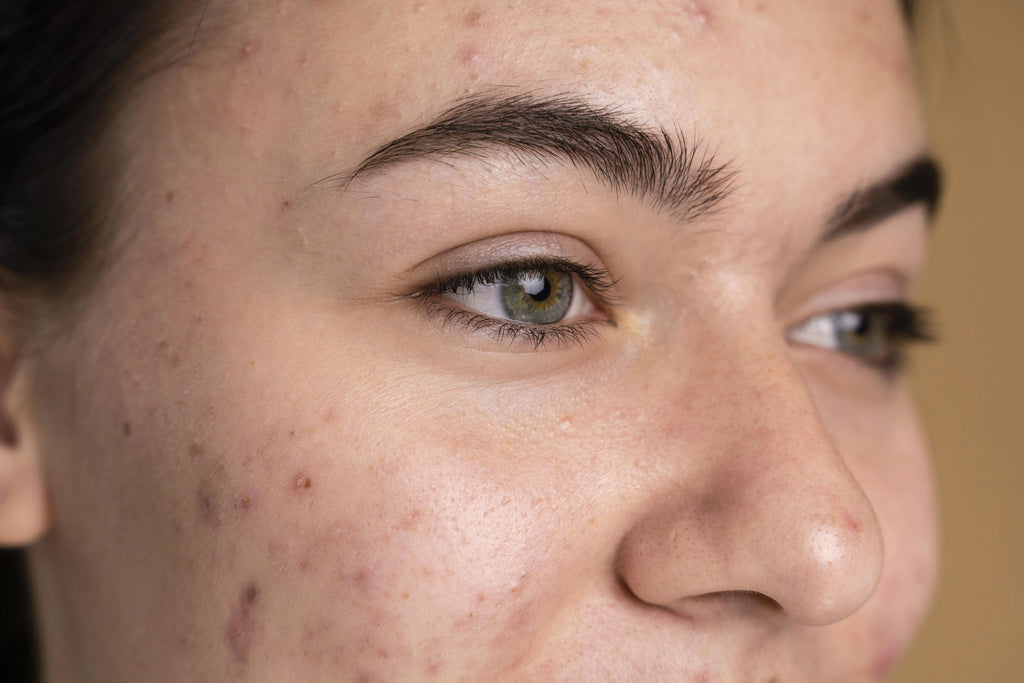 purgadelapiel-acne-skincare-cuidadofacial