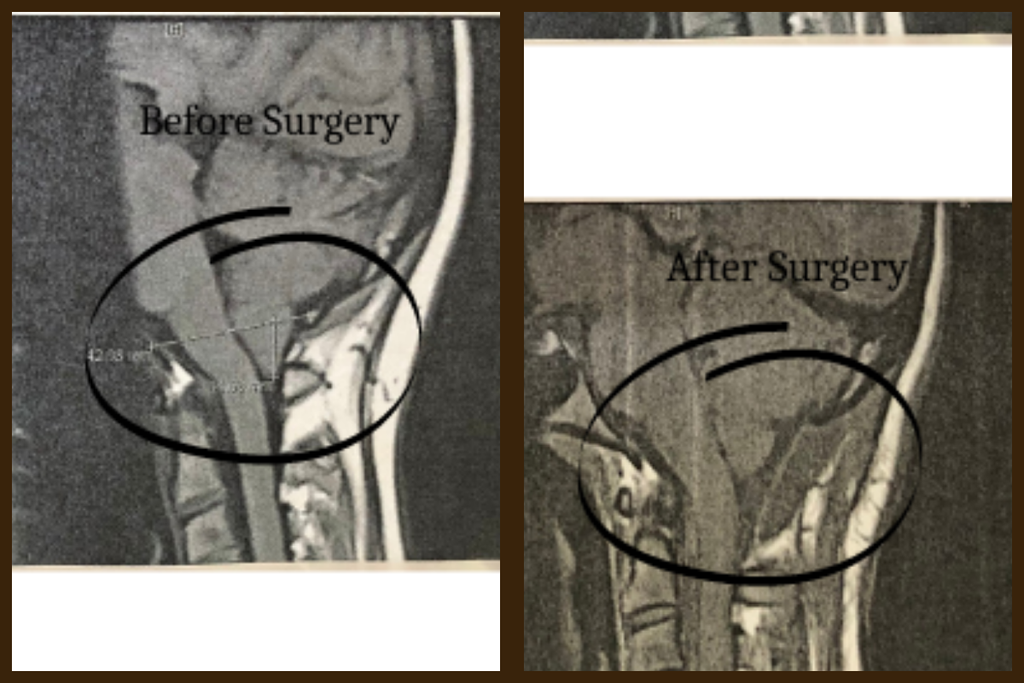 Before and after Chiari Malformation surgery