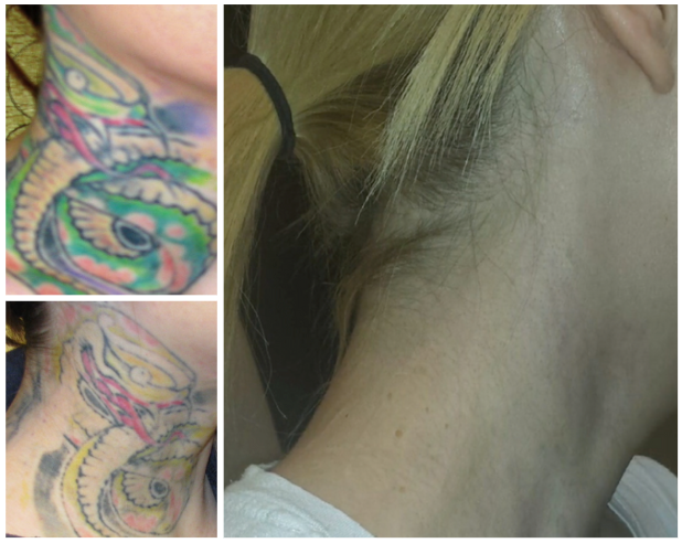 Tattoo Removal Richmond VA  Cassie Lane Aesthetics