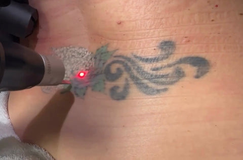 Tattoo removal in Virginia Beach - PicoSure Pro laser tattoo removal on lower back