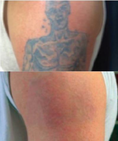 tattoo removal on arm before and after - PicoSure Pro laser tattoo removal in Virginia Beach, Virginia