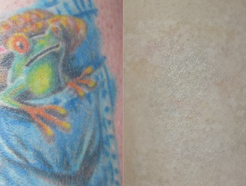 tattoo removal in Virginia Beach - fading and removing color tattoo ink