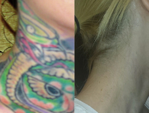 colorful tattoo removal on the neck - PicoSure Pro laser removes even the most colorful tattoo inks like blue, green & orange