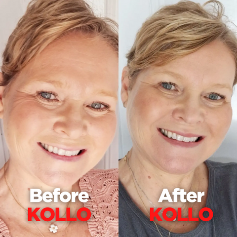 Carwen Before & After Kollo Collagen