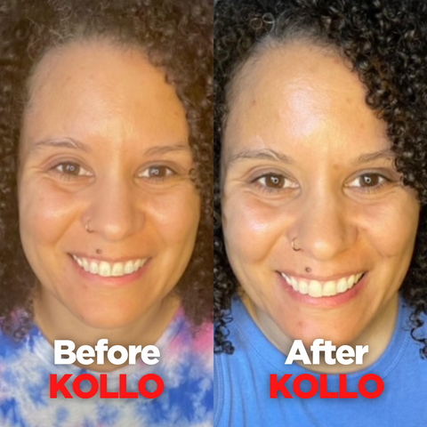 Rachel N Before and After Kollo