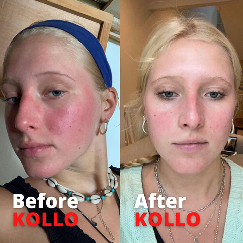 Before and After Kollo