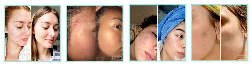 Results from the real-u Green Acne Control Serum