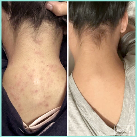 real-u before and after acne results