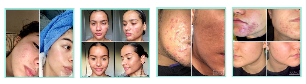 adult acne results grid 