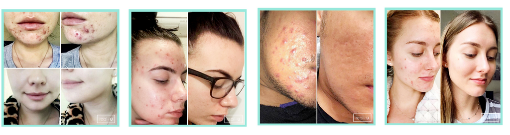 What you need to know to clear acne and pimples