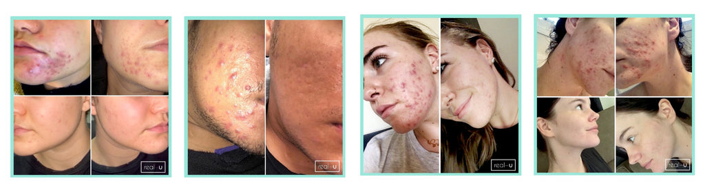 Cystic acne skincare results