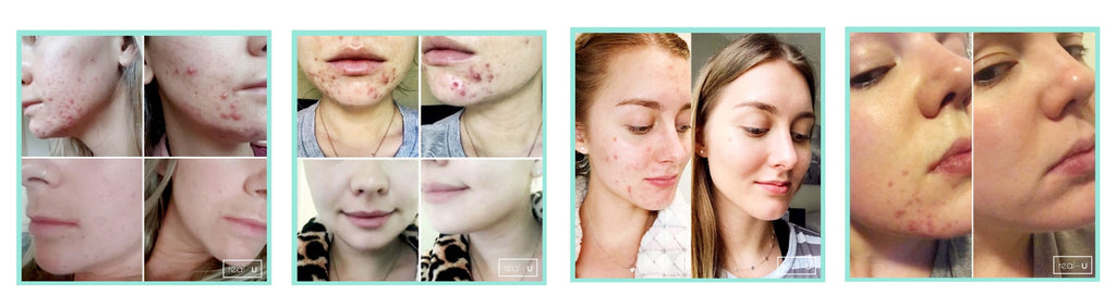 Hormonal acne skincare results grid 