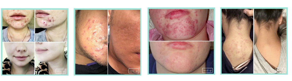 Skincare Results with red CONTROL Acne Serum