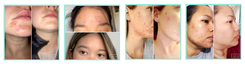 real-u results - what happens when you avoid stripping your skin