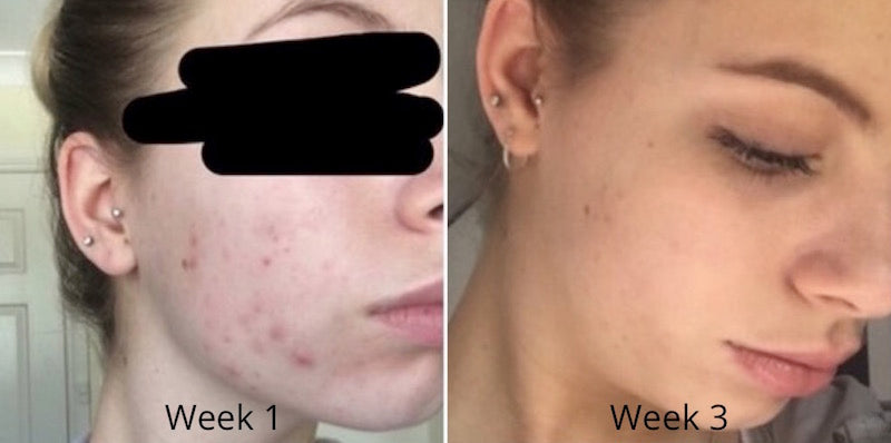 Em's acne skincare journey- weeks 1-3