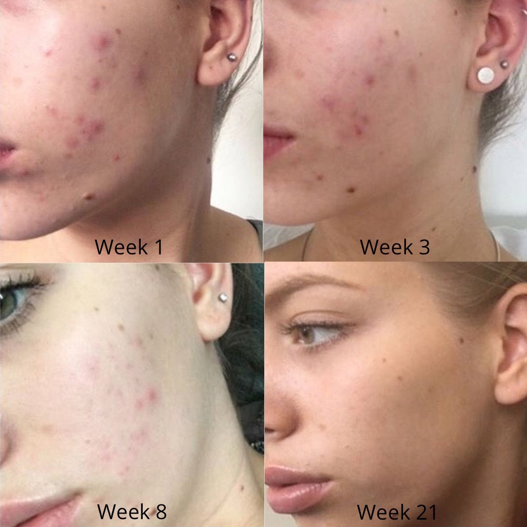 Em's acne skincare results -weeks 1-21