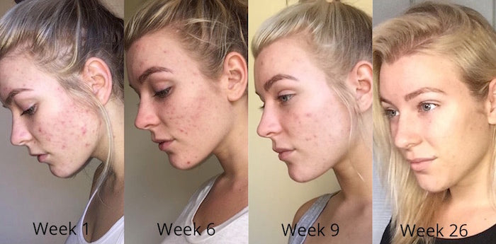 Esther's acne skin results weeks 1-26 left side of face