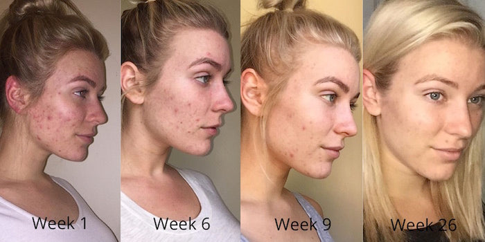 Esther's acne skin results weeks 1-26 right side of face