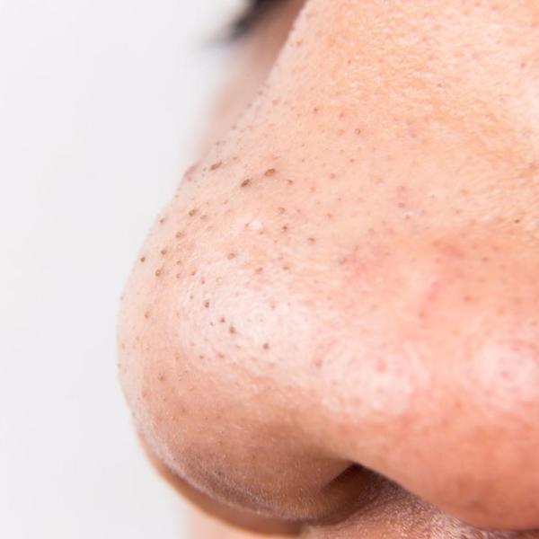 Blackheads across nose 