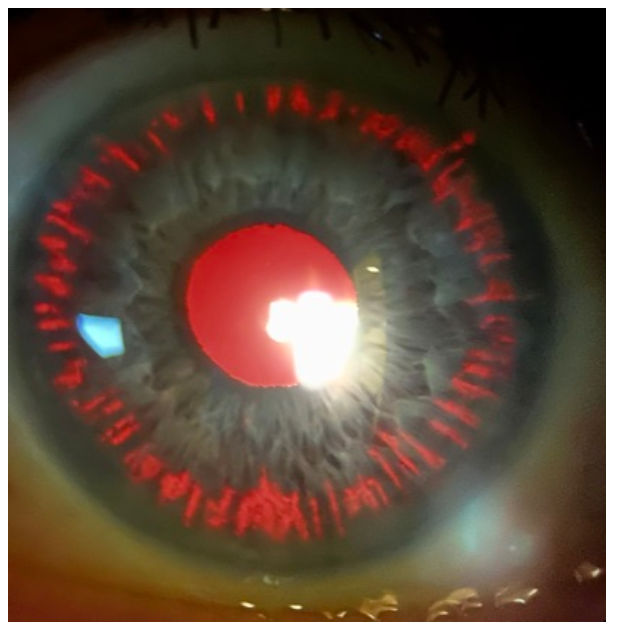 iris retroillumination in pigmentary dispersion syndrome