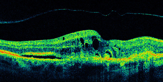 OCT image of wet macular degeneration