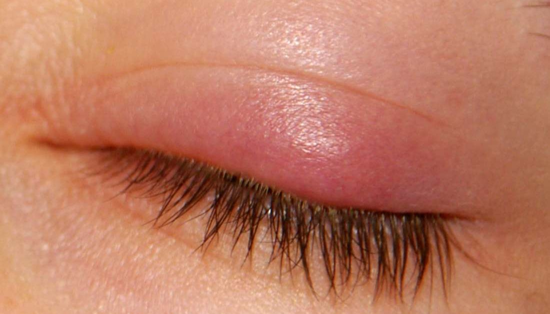 chalazion (stye) of upper eyelid