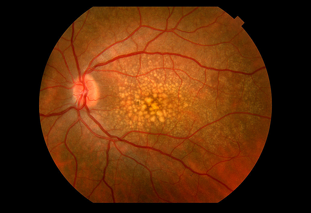 appearance of drusen in retina