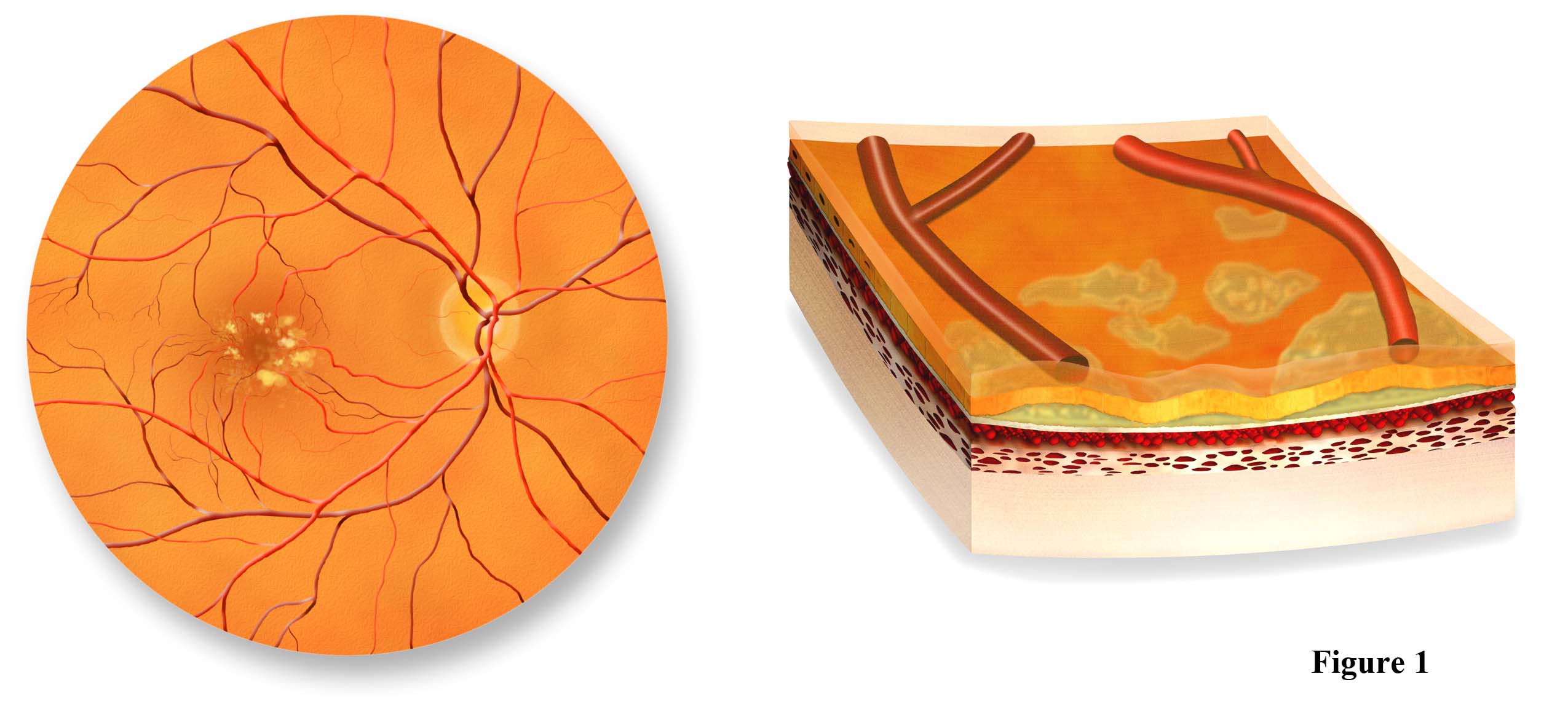 drusen of retina in the macula